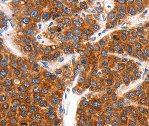 Immunohistochemistry of paraffin-embedded Human liver cancer tissue using KCNC2 Polyclonal Antibody at dilution 1:100