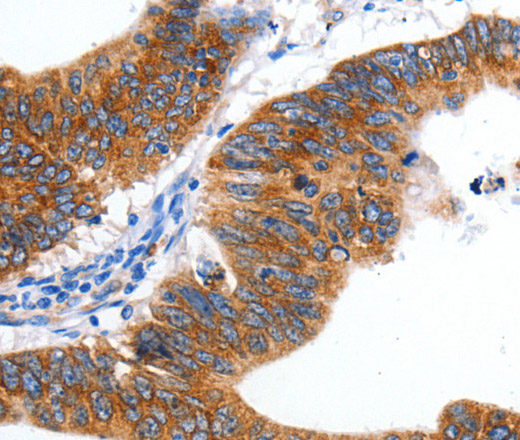 Immunohistochemistry of paraffin-embedded Human colon cancer tissue using KCNC2 Polyclonal Antibody at dilution 1:100