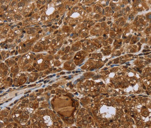 Immunohistochemistry of paraffin-embedded Human thyroid cancer using STMN2/3/4 Polyclonal Antibody at dilution of 1:45