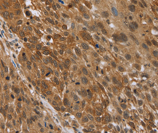 Immunohistochemistry of paraffin-embedded Human lung cancer using STMN2/3/4 Polyclonal Antibody at dilution of 1:45