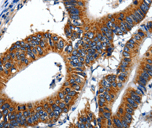 Immunohistochemistry of paraffin-embedded Human colon cancer using LAMA1 Polyclonal Antibody at dilution of 1:70