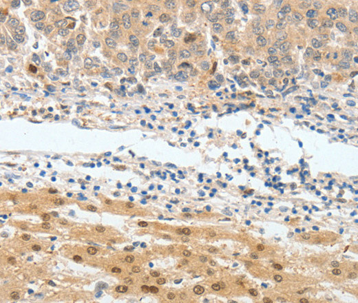 Immunohistochemistry of paraffin-embedded Human lung cancer tissue using BPIFB2 Polyclonal Antibody at dilution 1:45