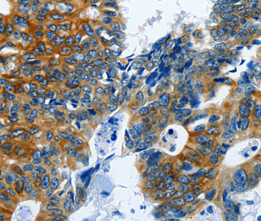 Immunohistochemistry of paraffin-embedded Human colon cancer using BPIFB3 Polyclonal Antibody at dilution of 1:120