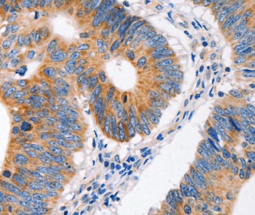 Immunohistochemistry of paraffin-embedded Human colon cancer tissue using MC1R Polyclonal Antibody at dilution 1:100