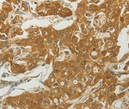 Immunohistochemistry of paraffin-embedded Human ovarian cancer tissue using MC4R Polyclonal Antibody at dilution 1:50