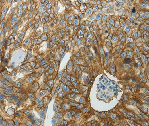 Immunohistochemistry of paraffin-embedded Human ovarian cancer tissue using SLC16A1 Polyclonal Antibody at dilution 1:50