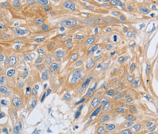 Immunohistochemistry of paraffin-embedded Human esophagus cancer using SLC16A7 Polyclonal Antibody at dilution of 1:30