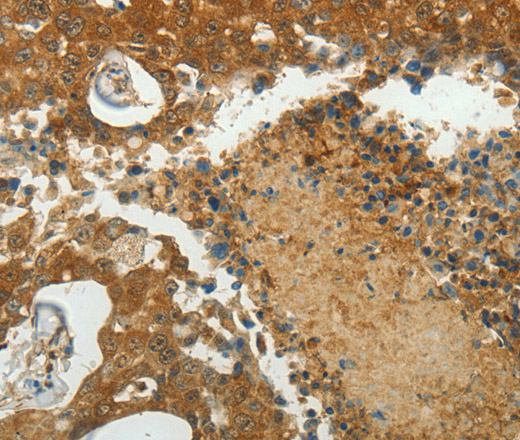 Immunohistochemistry of paraffin-embedded Human breast cancer using MCM4 Polyclonal Antibody at dilution of 1:40