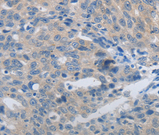 Immunohistochemistry of paraffin-embedded Human ovarian cancer using MMP8 Polyclonal Antibody at dilution of 1:45