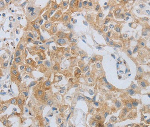 Immunohistochemistry of paraffin-embedded Human lung cancer using MMP25 Polyclonal Antibody at dilution of 1:80