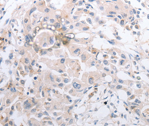 Immunohistochemistry of paraffin-embedded Human lung cancer using MMP11 Polyclonal Antibody at dilution of 1:40