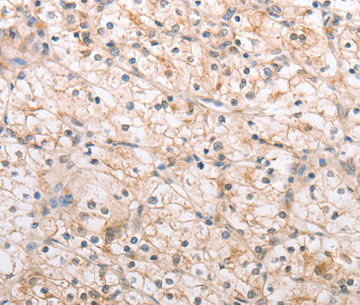 Immunohistochemistry of paraffin-embedded Human renal cancer using MMP11 Polyclonal Antibody at dilution of 1:40