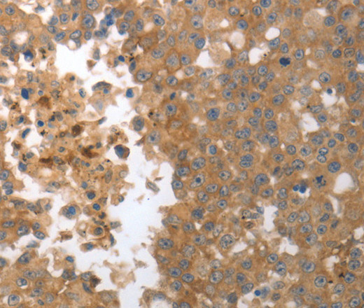 Immunohistochemistry of paraffin-embedded Human breast cancer tissue using MMP27 Polyclonal Antibody at dilution 1:50