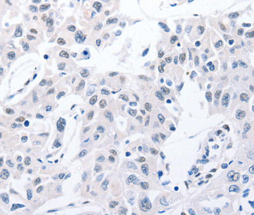 Immunohistochemistry of paraffin-embedded Human lung cancer using POMC Polyclonal Antibody at dilution of 1:30