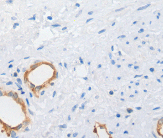 Immunohistochemistry of paraffin-embedded Human cervical cancer tissue using MUC5AC Polyclonal Antibody at dilution 1:100