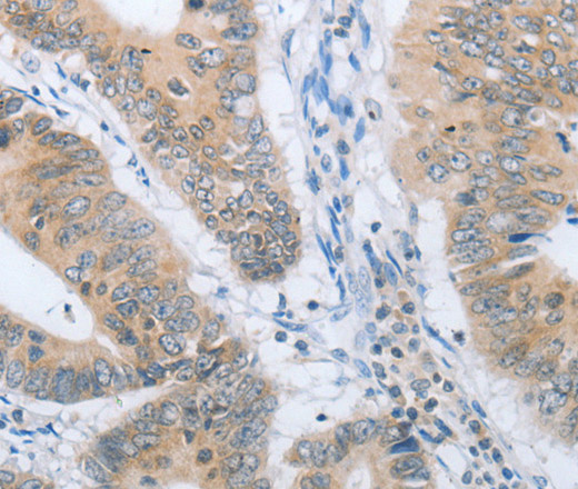 Immunohistochemistry of paraffin-embedded Human colon cancer tissue using CHRNA10 Polyclonal Antibody at dilution 1:50