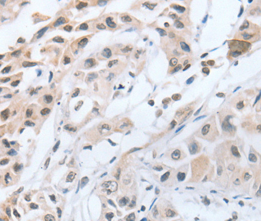 Immunohistochemistry of paraffin-embedded Human lung cancer tissue using CHRNA10 Polyclonal Antibody at dilution 1:50