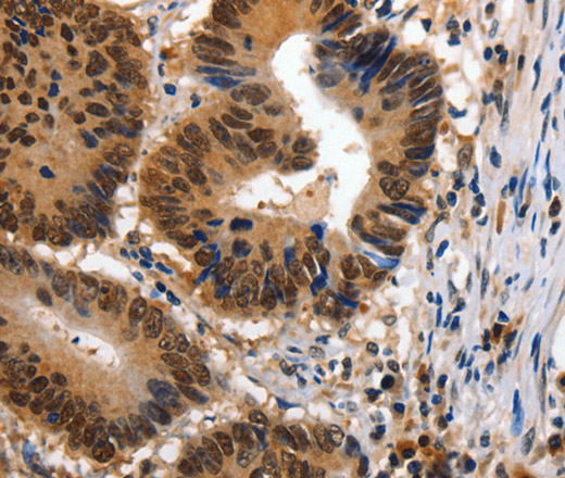 Immunohistochemistry of paraffin-embedded Human colon cancer using 14-3-3 epsilon Polyclonal Antibody at dilution of 1:100