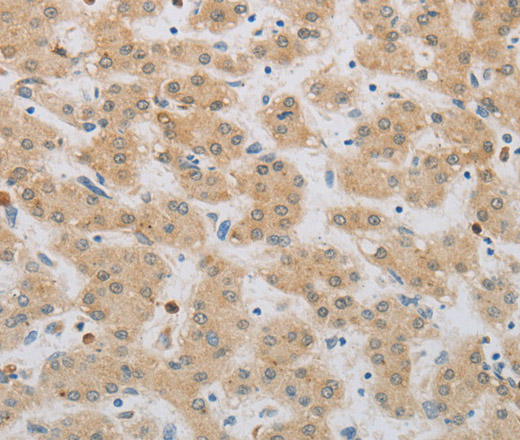 Immunohistochemistry of paraffin-embedded Human liver cancer tissue using NBN Polyclonal Antibody at dilution 1:50