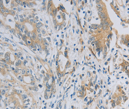 Immunohistochemistry of paraffin-embedded Human gastric cancer tissue using NBN Polyclonal Antibody at dilution 1:50