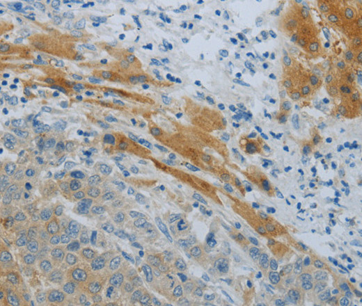 Immunohistochemistry of paraffin-embedded Human liver cancer using NPHS1 Polyclonal Antibody at dilution of 1:40