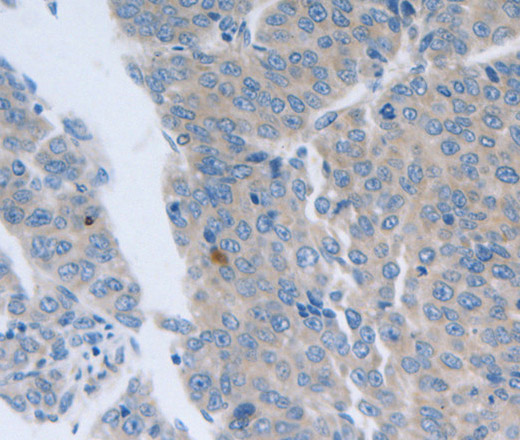 Immunohistochemistry of paraffin-embedded Human liver cancer tissue using GRIN1 Polyclonal Antibody at dilution 1:50