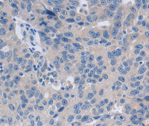 Immunohistochemistry of paraffin-embedded Human ovarian cancer tissue using GRIN1 Polyclonal Antibody at dilution 1:50