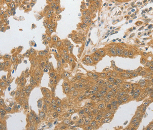 Immunohistochemistry of paraffin-embedded Human ovarian cancer tissue using GRIN2C Polyclonal Antibody at dilution 1:80