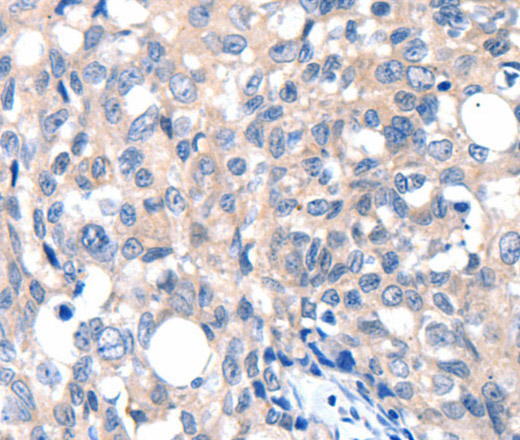 Immunohistochemistry of paraffin-embedded Human breast cancer tissue using GRIN2D Polyclonal Antibody at dilution 1:30