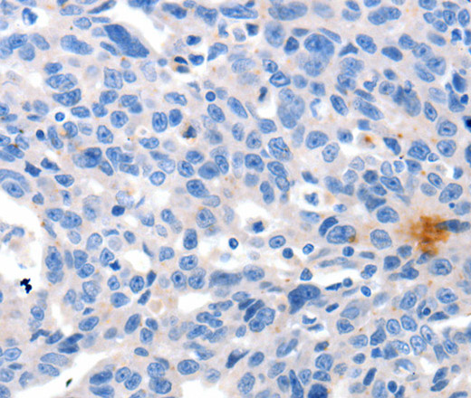 Immunohistochemistry of paraffin-embedded Human ovarian cancer tissue using GRIN2D Polyclonal Antibody at dilution 1:30