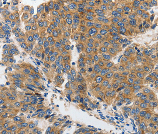 Immunohistochemistry of paraffin-embedded Human liver cancer tissue using GluR2 Polyclonal Antibody at dilution 1:70