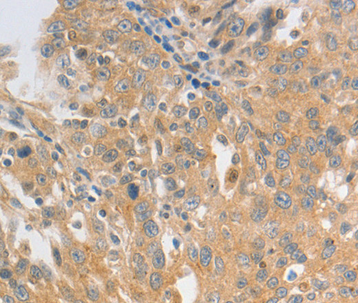 Immunohistochemistry of paraffin-embedded Human ovarian cancer tissue using HCRTR2 Polyclonal Antibody at dilution 1:50