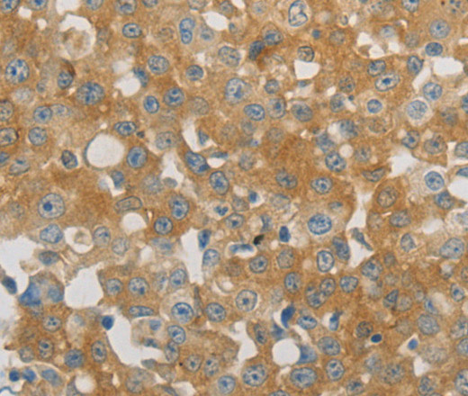 Immunohistochemistry of paraffin-embedded Human breast cancer using PLPP1 Polyclonal Antibody at dilution of 1:40