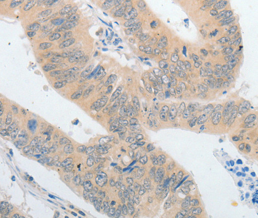 Immunohistochemistry of paraffin-embedded Human colon cancer using PLPP1 Polyclonal Antibody at dilution of 1:40