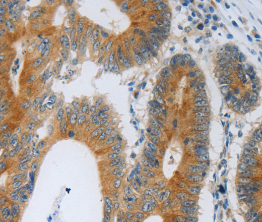 Immunohistochemistry of paraffin-embedded Human colon cancer using F2R Polyclonal Antibody at dilution of 1:40