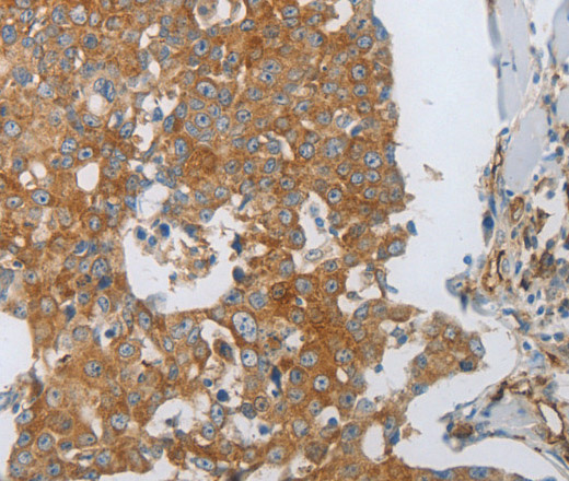 Immunohistochemistry of paraffin-embedded Human breast cancer using CD31 Polyclonal Antibody at dilution of 1:30