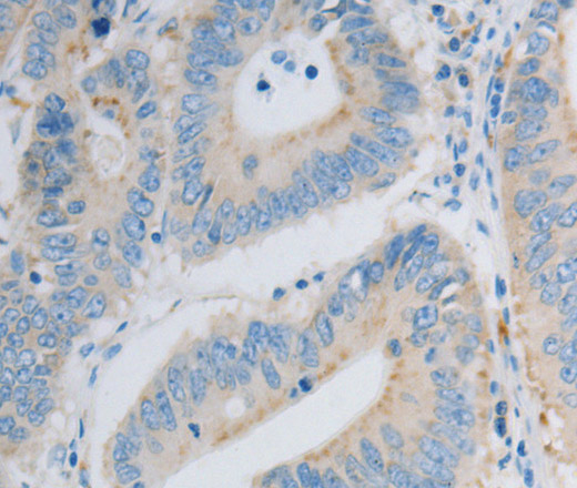 Immunohistochemistry of paraffin-embedded Human colon cancer using PDX1 Polyclonal Antibody at dilution of 1:30