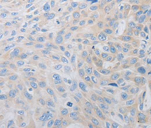 Immunohistochemistry of paraffin-embedded Human esophagus cancer using PDX1 Polyclonal Antibody at dilution of 1:30