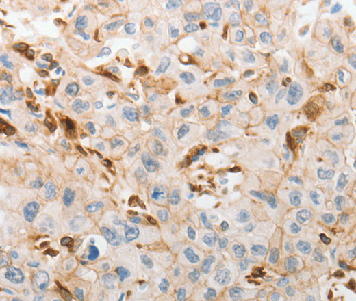 Immunohistochemistry of paraffin-embedded Human lung cancer tissue using SLC15A2 Polyclonal Antibody at dilution 1:60