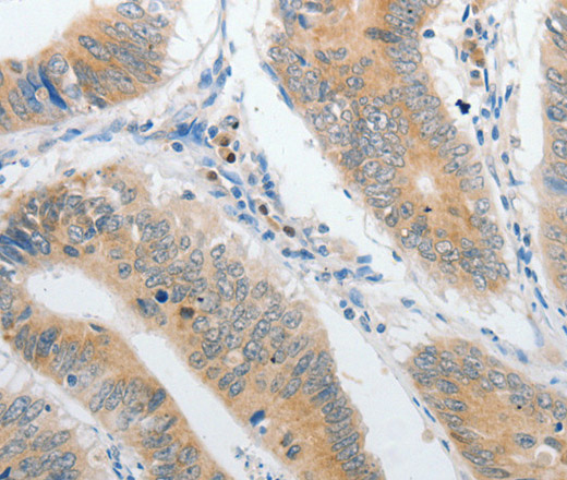 Immunohistochemistry of paraffin-embedded Human colon cancer tissue using PIBF1 Polyclonal Antibody at dilution 1:60