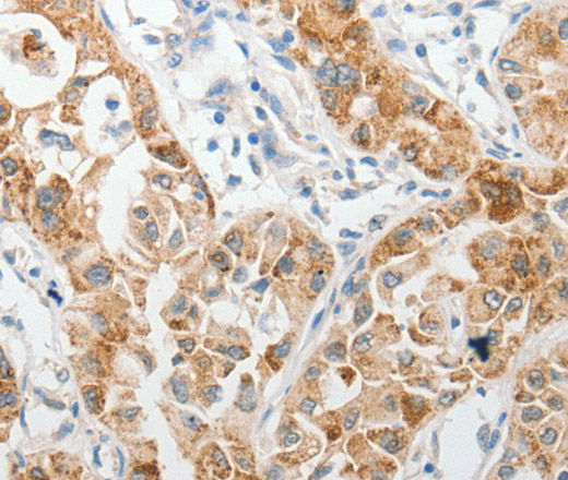 Immunohistochemistry of paraffin-embedded Human lung cancer tissue using PIBF1 Polyclonal Antibody at dilution 1:60