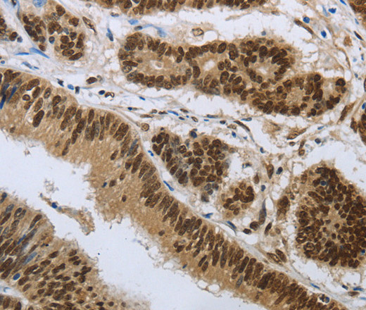 Immunohistochemistry of paraffin-embedded Human colon cancer tissue using PRMT3 Polyclonal Antibody at dilution 1:30