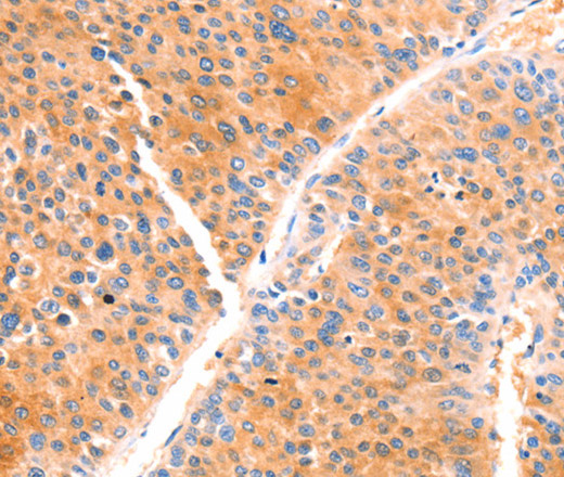 Immunohistochemistry of paraffin-embedded Human liver cancer using PRDX2 Polyclonal Antibody at dilution of 1:80