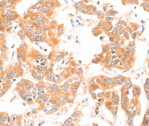 Immunohistochemistry of paraffin-embedded Human breast cancer using PRDX2 Polyclonal Antibody at dilution of 1:80