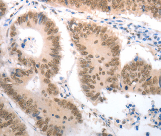 Immunohistochemistry of paraffin-embedded Human colon cancer tissue using RAD52 Polyclonal Antibody at dilution 1:50