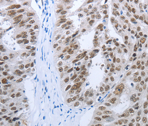 Immunohistochemistry of paraffin-embedded Human ovarian cancer tissue using RBMS1 Polyclonal Antibody at dilution 1:30