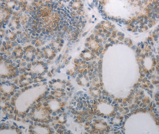 Immunohistochemistry of paraffin-embedded Human thyroid cancer using RBMS3 Polyclonal Antibody at dilution of 1:70