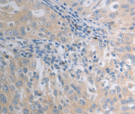 Immunohistochemistry of paraffin-embedded Human ovarian cancer tissue using SHH Polyclonal Antibody at dilution 1:40