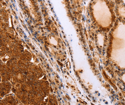 Immunohistochemistry of paraffin-embedded Human thyroid cancer tissue using SLC9A3R2 Polyclonal Antibody at dilution 1:40