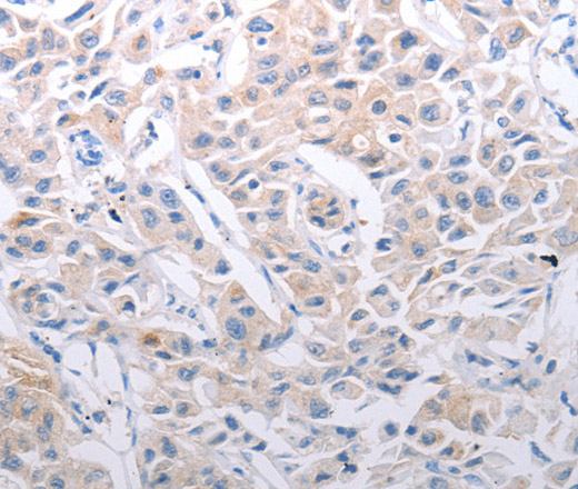 Immunohistochemistry of paraffin-embedded Human lung cancer using SLC39A6 Polyclonal Antibody at dilution of 1:30